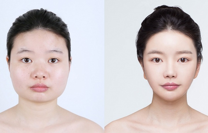 Plastická operace obličeje